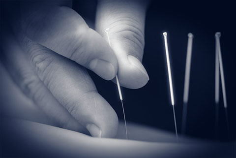 Acupuncture