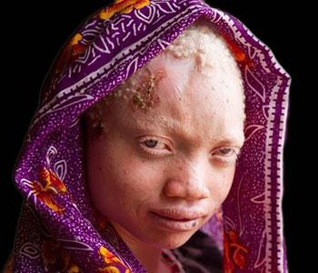 Albinos en Afrique